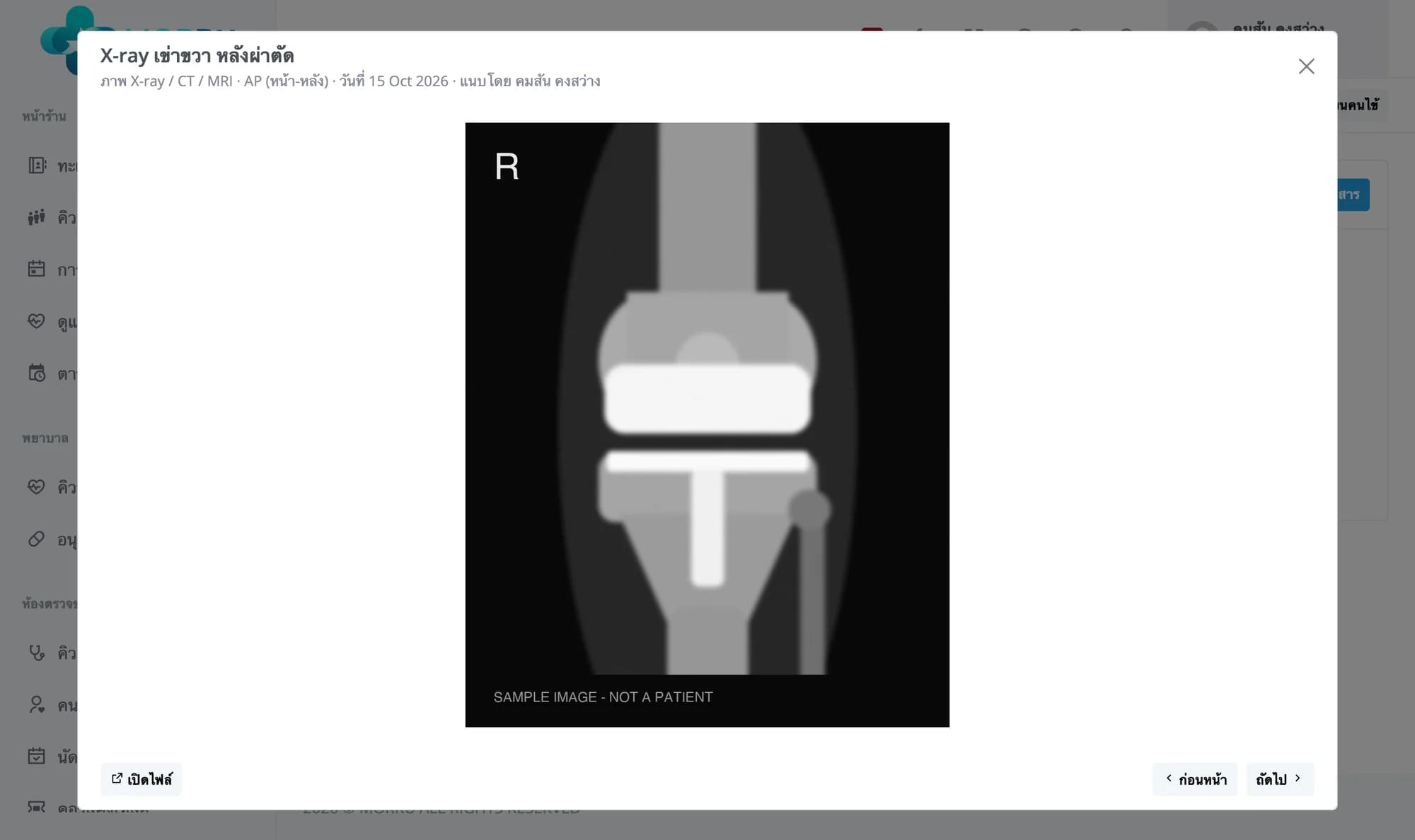 ภาพ X-ray เข่าขวาหลังผ่าตัดเปิดเต็มกล่อง หัวกล่องบอกประเภท ชนิดภาพ วันที่ และผู้แนบ